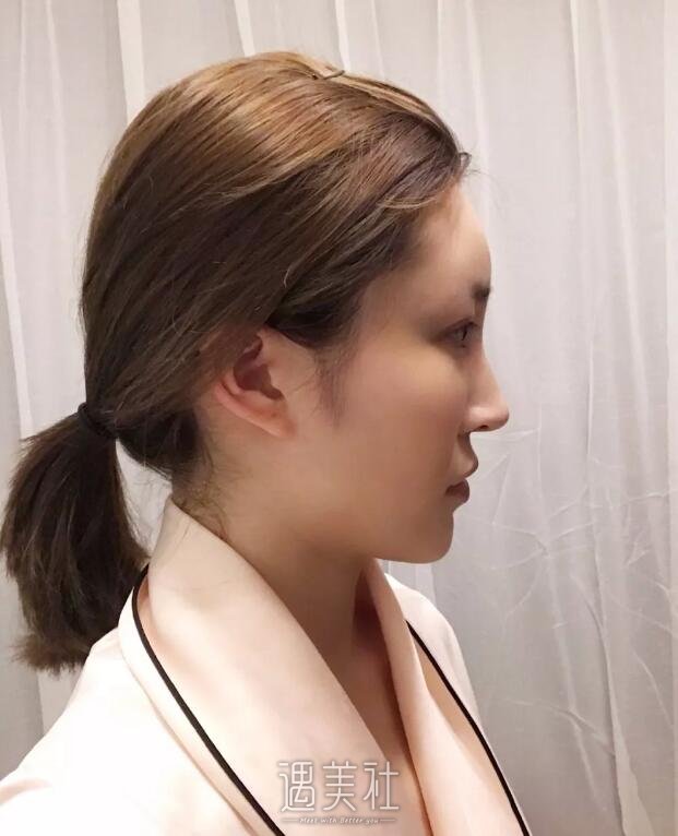 北京东方和谐面部脂肪填充技术如何?有真实案例吗?