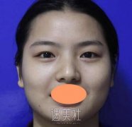 唐都李跃军双眼皮案例，分享术后1个月恢复图~ width=