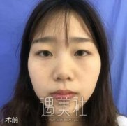 米兰高亮双眼皮案例 分享我的变美过程 width=