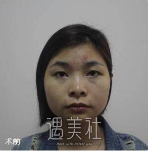 华西,李正勇,隆鼻