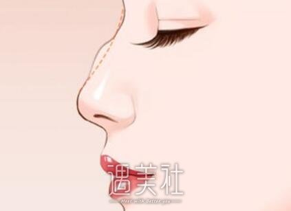 梧州,矫正驼峰鼻