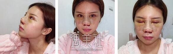 军美,章小平,隆鼻
