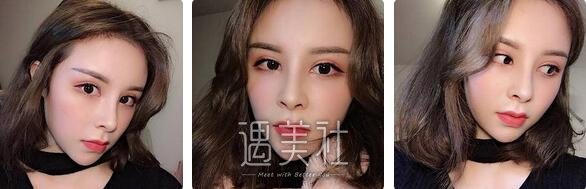 军美,章小平,隆鼻