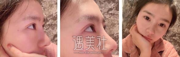 军美,章小平,隆鼻