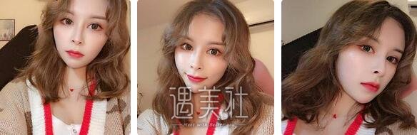 军美章小平隆鼻怎么样？有没有案例？ width=