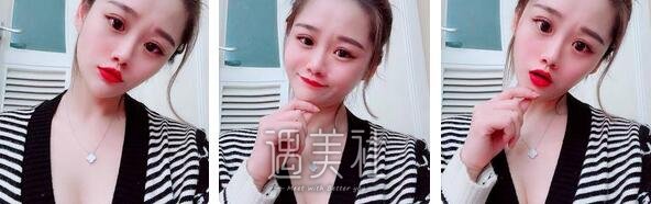 万连壮,假体隆胸
