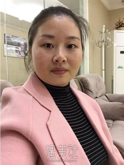 大连中心医院做双眼皮果好吗?真实案例为你诠释!