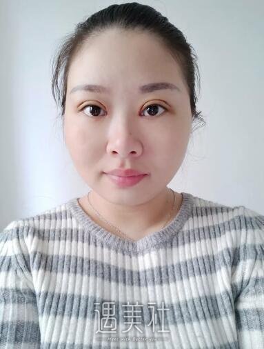 大连中心医院做双眼皮果好吗?真实案例为你诠释!