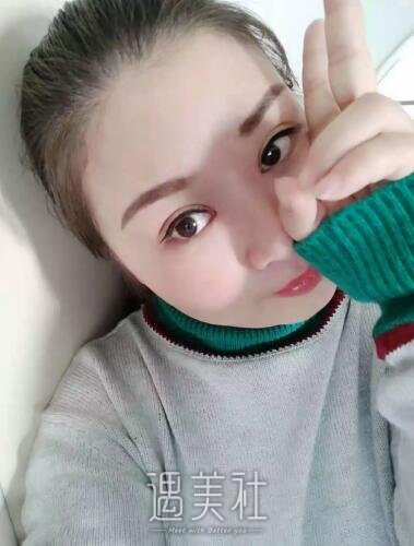 大连中心医院做双眼皮果好吗?真实案例为你诠释!