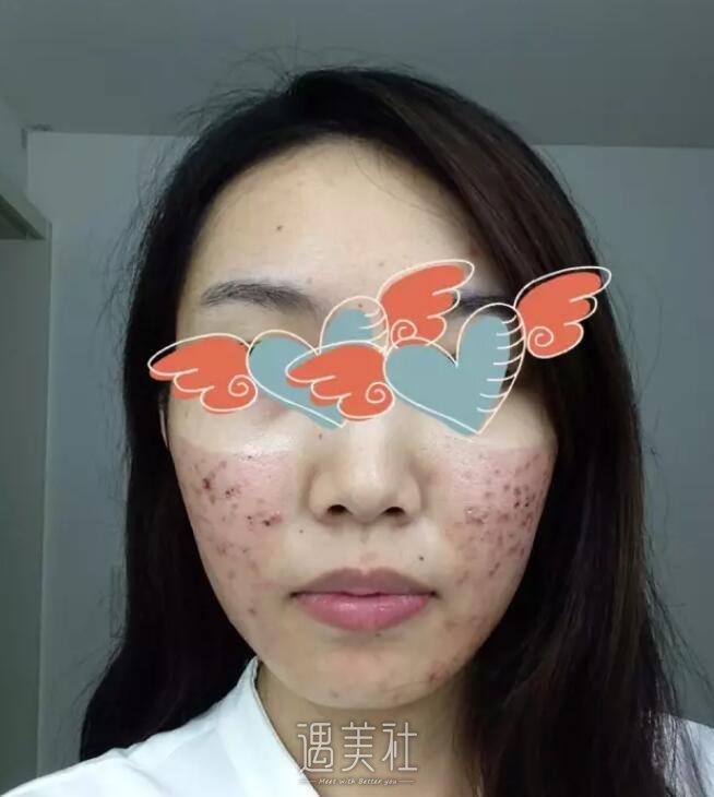 大连医大二院整形科点阵激光怎么样?痤疮疤痕的克星!