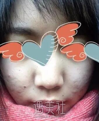 大连医大二院整形科点阵激光怎么样?痤疮疤痕的克星!