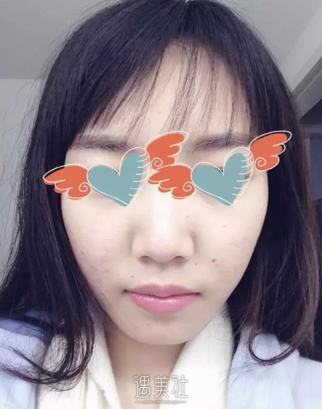 大连医大二院整形科点阵激光怎么样?痤疮疤痕的克星!
