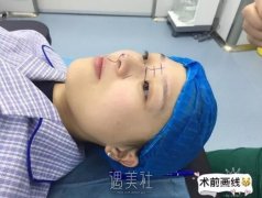 广西医科大整形医院隆鼻案例展示，小翘鼻就是好看! width=