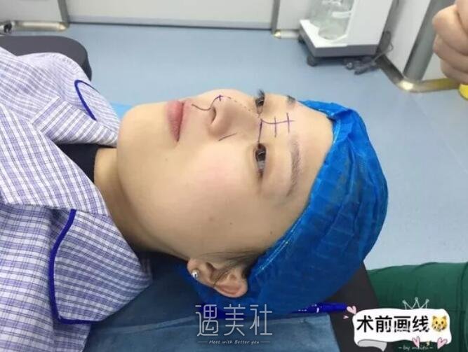 广西医科大整形医院隆鼻案例展示，小翘鼻就是好看!