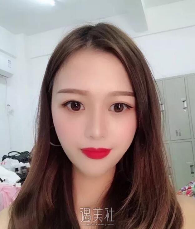 广西医科大整形医院隆鼻案例展示，小翘鼻就是好看!