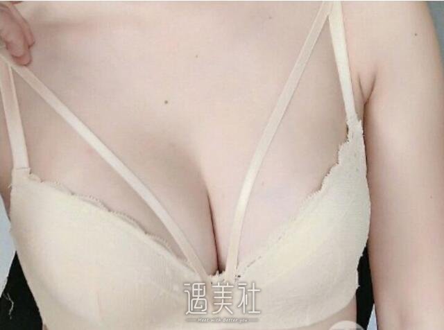 广西医科大整形医院隆胸案例|从此过上与众不同的生活