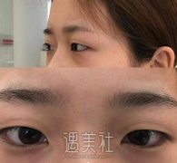 郑大一附院王琪影医生做的全切双眼皮怎么样？案例~ width=