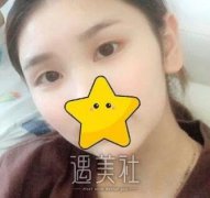 九院周一雄双眼皮案例：大眼睛让我变亲切很多~ width=