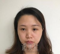 北京王军隆鼻真正案例，附术后一个月恢复图~ width=