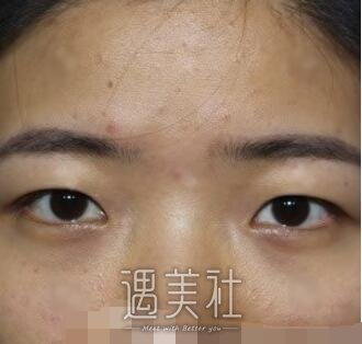 华西医院,卿勇,割双眼皮