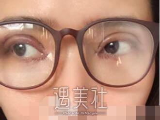 华西医院,卿勇,割双眼皮