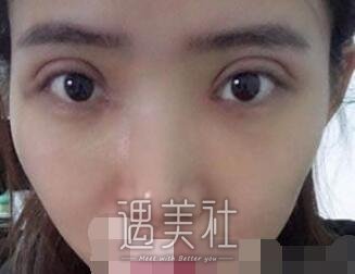 华西医院,卿勇,割双眼皮
