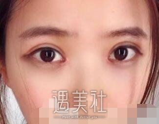 华西医院,卿勇,割双眼皮