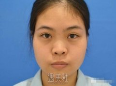 西京医院整形科鼻部手术案例展示|真的是美出天际! width=
