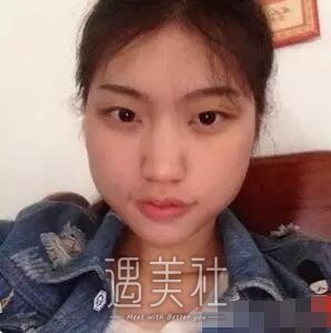 深圳北大医院瘦脸案例展示，气质瞬间提升!
