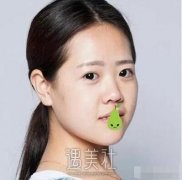 深圳北大医院双眼皮技术好吗?令人惊讶的案例展示! width=