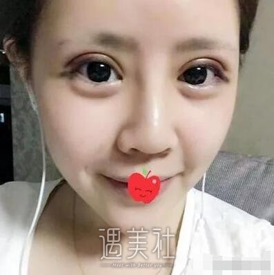 深圳北大医院双眼皮技术好吗?令人惊讶的案例展示!