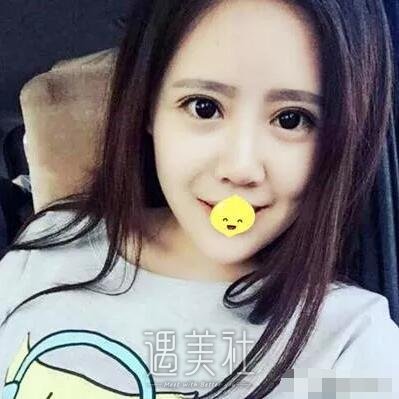 深圳北大医院双眼皮技术好吗?令人惊讶的案例展示!