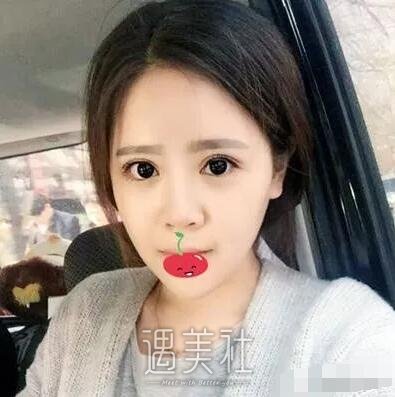 深圳北大医院双眼皮技术好吗?令人惊讶的案例展示!