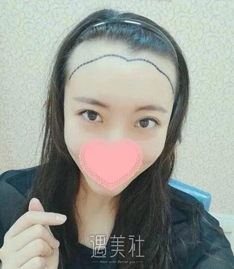 济南海峡医院植发怎么样?我想拥有正常的发际线!
