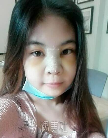 恩施华美整形医院做隆鼻技术如何?有真实案例吗?