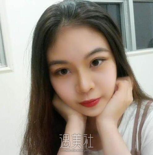 恩施华美整形医院做隆鼻技术如何?有真实案例吗?