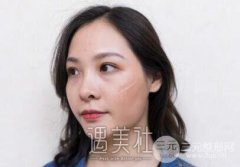 长沙亚韩整形医院做激光祛疤果如何?真实案例一览~ width=