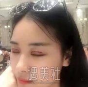 西安西京整形外科中心怎么样？全新眼部手术案例曝光！ width=