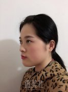 西安西美整形靠谱吗?内附面部吸脂瘦脸案例价目表 width=