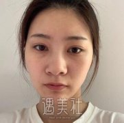 南京鼓楼医院整形科价目表：真实肋骨隆鼻152天前后对比图~ width=