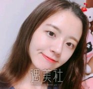 八大处靳小雷双眼皮案例：眼睛变得很有神！ width=