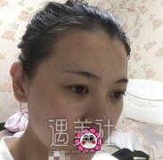 八大处王欢隆鼻案例图：精致的鼻子就是如此！ width=