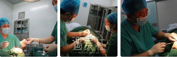 李发成,自体脂肪丰胸