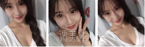 李发成,自体脂肪丰胸