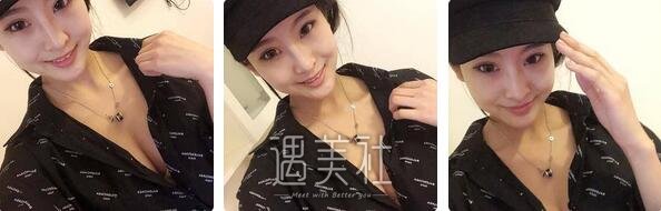 李发成,自体脂肪丰胸