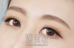 重庆做开眼角多少钱？价格主要和那些因素有关？ width=
