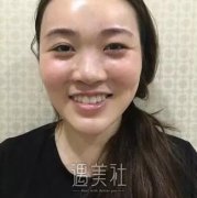 八大处刘墩鼻部手术案例|根本没人鼻子是做的! width=