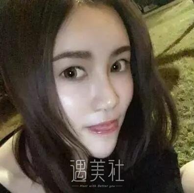 八大处刘墩鼻部手术案例|根本没人鼻子是做的!
