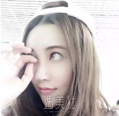 八大处刘墩鼻部手术案例|根本没人鼻子是做的!