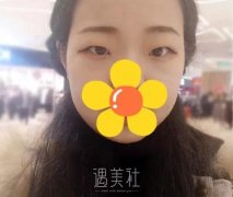 八大处于晓波双眼皮案例|手术前后变化巨大! width=